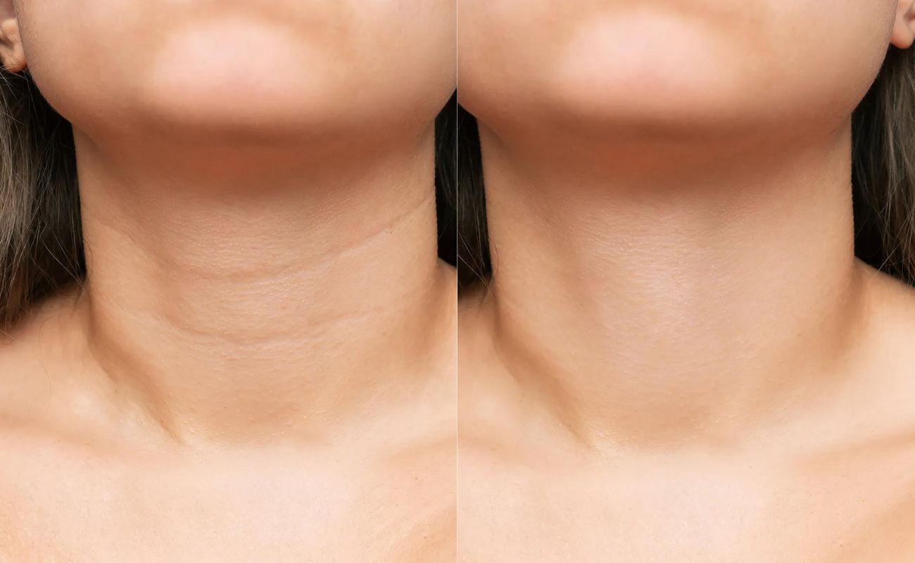 Before and after pictures of the neck