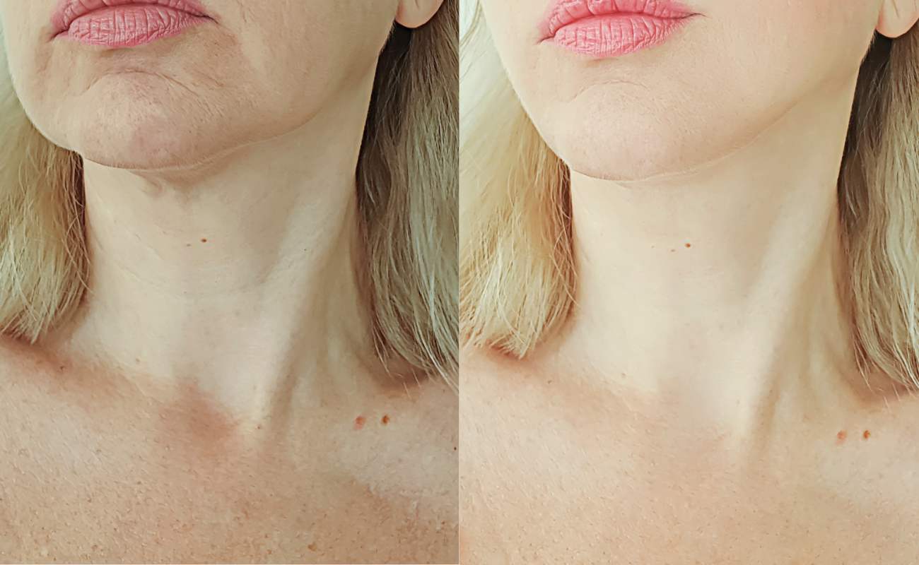 Before and after pictures of the neck