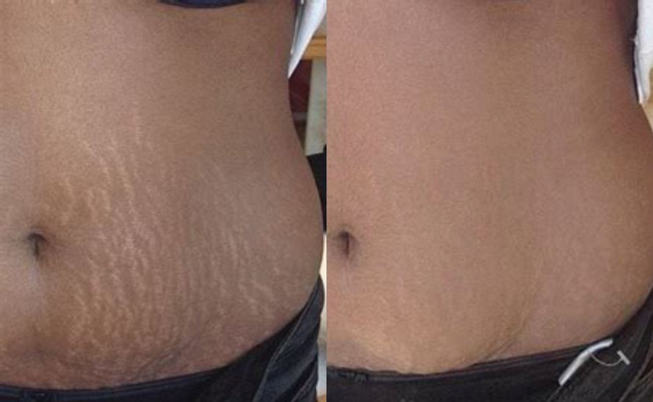 Comparison pictures before and after treating stretch marks with pcl mono threads