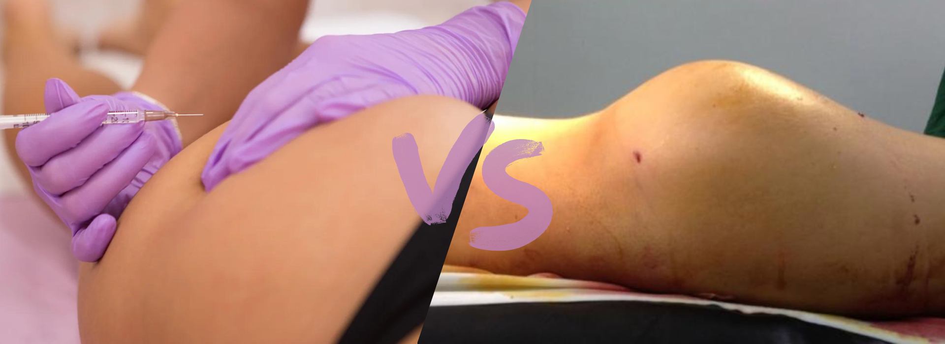 Hyaluronic Acid Fillers for Buttocks VS BBL