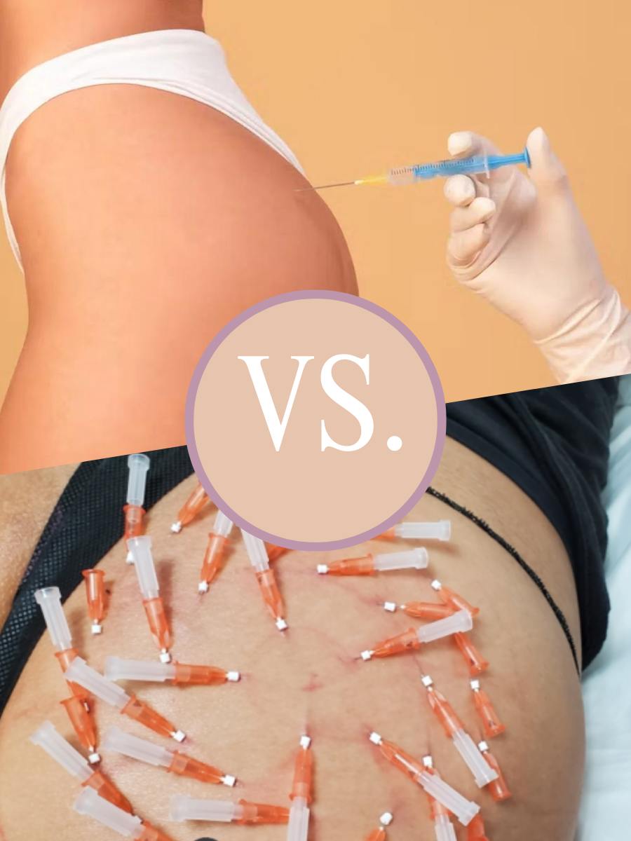 Hyaluronic Acid Fillers for Buttocks VS Thread Lifting Buttocks
