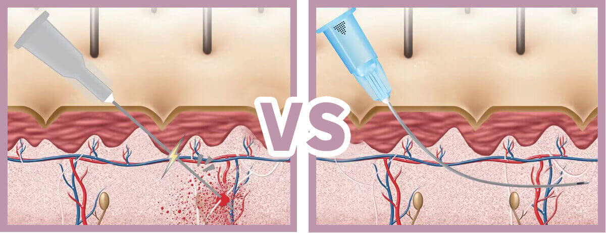 Other Dermal Filler Injecting Techniques