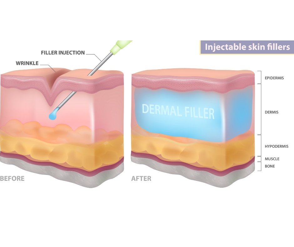 Dermal Filler For Wrinkle Dermal Filler For Wrinkle