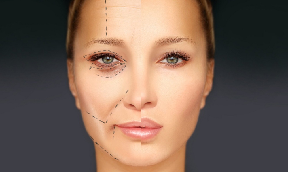 Is Threading Face Lift Permanent