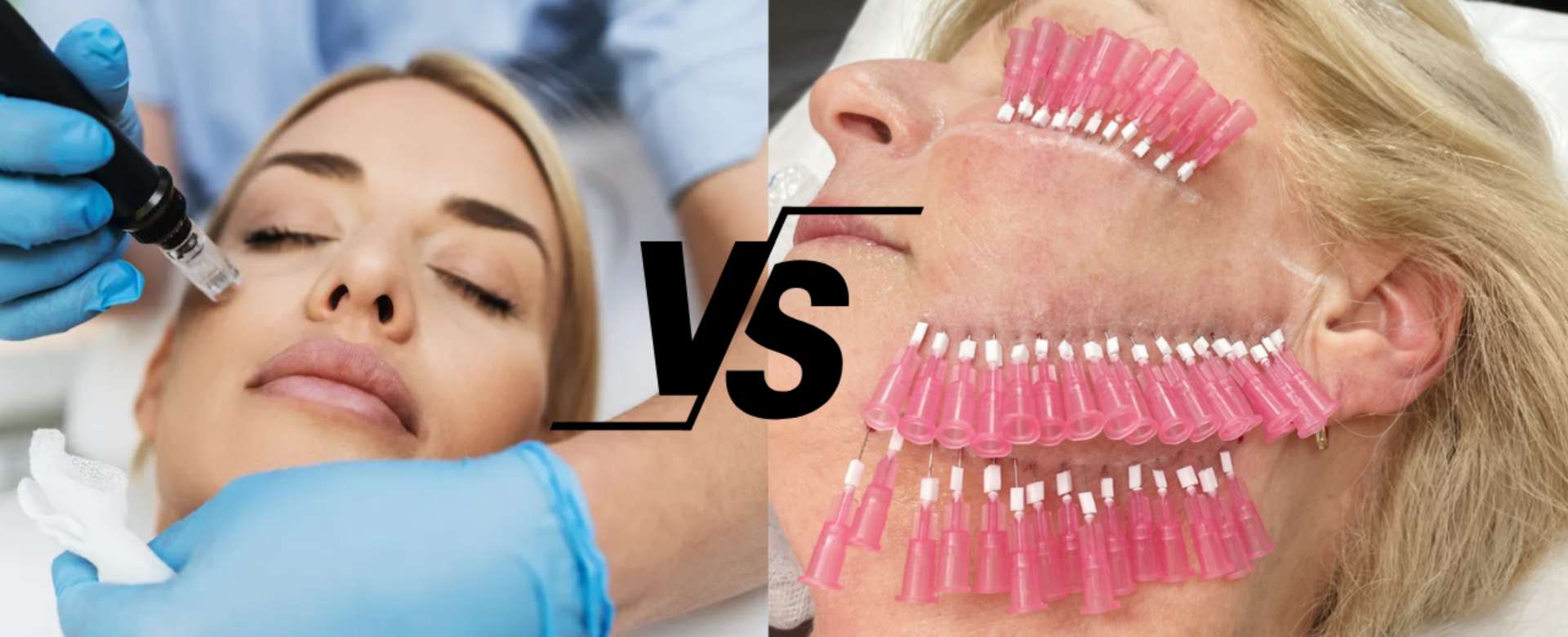 Microneedling VS Smooth Threads For Acne Scars Microneedling VS Smooth Threads For Acne Scars