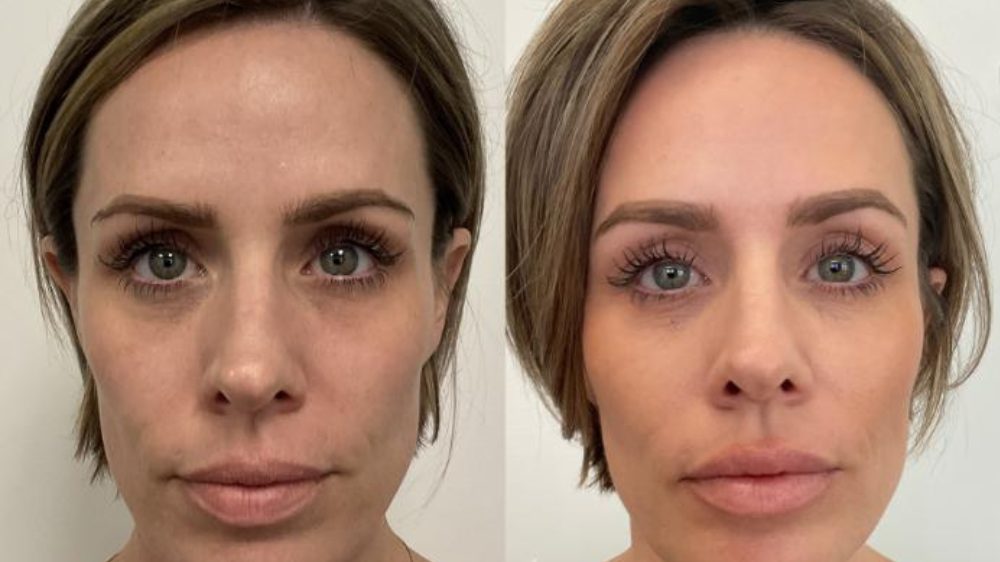 Smooth Threads Under Eyes Before And After