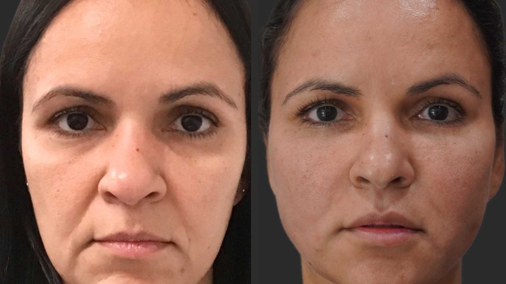 Smooth Threads Under Eyes Before And After