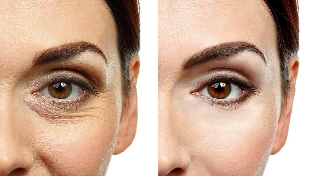 Smooth Threads Under Eyes Before And After