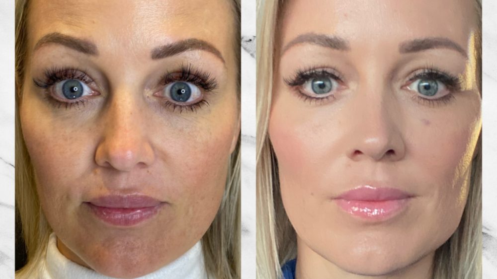 Smooth Threads Under Eyes Before And After